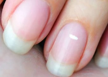 Tırnakta beyaz lekeler nasıl çıkar? Beyaz lekelerin nedeni nedir? Tırnakta oluşan beyaz lekeleri gidermenin yolları…