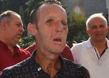 Yüz nakli yapılan Recep Sert’e uyuşturucu davasında tahliye